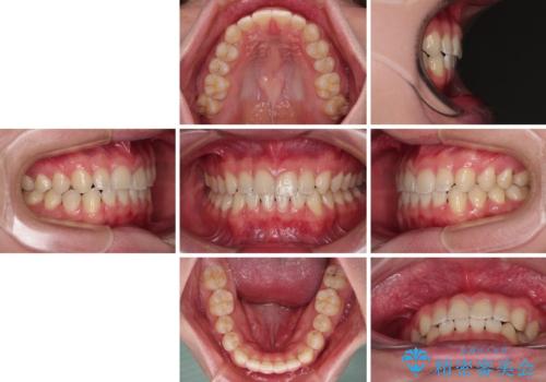 隙間とデコボコを治したい ワイヤー装置による矯正治療の治療後