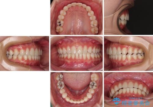 隙間の多い歯並びをインビザラインで矯正治療の治療後