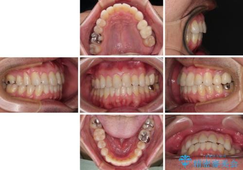 内側に転位した歯とボロボロのむし歯　インビザラインによる矯正治療とむし歯治療の治療後