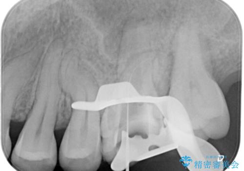 【見逃し根管を発見】根管治療〜セラミッククラウンの治療中