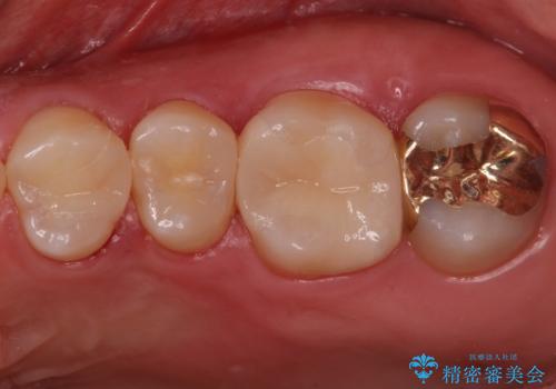 歯と歯の間の虫歯 インレーでの治療(セラミック・ゴールド)の症例 治療後