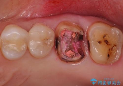 検査で見つかった虫歯 セラミッククラウンでの治療の治療中