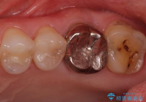 検査で見つかった虫歯　セラミッククラウンでの治療の症例 治療前
