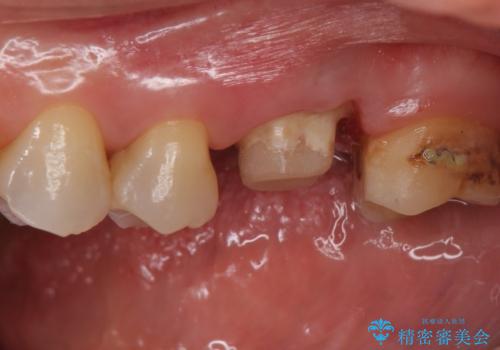 検査で見つかった虫歯 セラミッククラウンでの治療の治療中