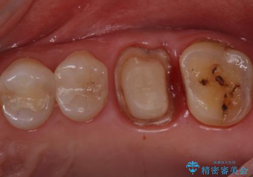 検査で見つかった虫歯 セラミッククラウンでの治療の治療中