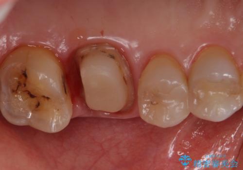 検査で見つかった虫歯 セラミッククラウンでの治療の治療中