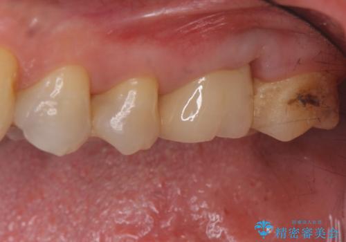 検査で見つかった虫歯 セラミッククラウンでの治療の治療後