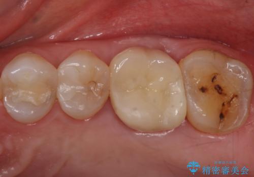 検査で見つかった虫歯　セラミッククラウンでの治療の症例 治療後