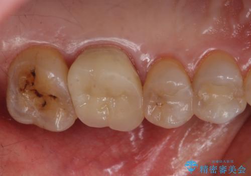 検査で見つかった虫歯 セラミッククラウンでの治療の治療後