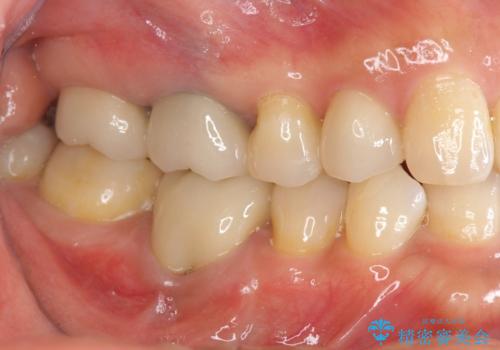 [ 金属アレルギー ] 銀歯を除去するメタルフリー治療の症例 治療後