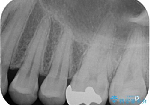 歯と歯の間の虫歯　インレーでの治療(セラミック・ゴールド)の治療前