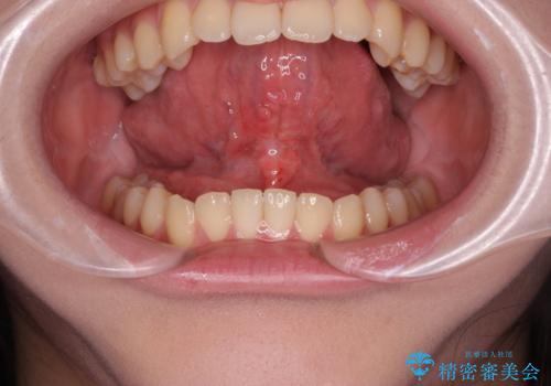舌が短く話しづらい、滑舌を改善する小手術の症例 治療後