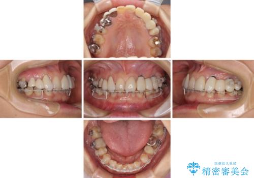 割れてしまった歯が痛む 矯正とインプラントを併用した総合歯科治療の治療中