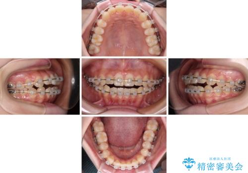 隙間が空いてデコボコした前歯を治したい ワイヤー装置による矯正治療の治療中