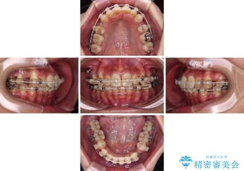 八重歯と出っ歯を治したい ワイヤー装置での抜歯矯正の治療中