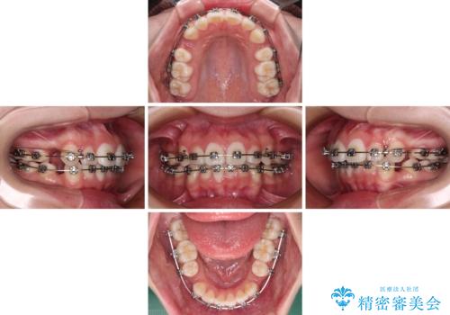 前歯のデコボコとクロスバイトを治したい ワイヤー装置による抜歯矯正の治療中