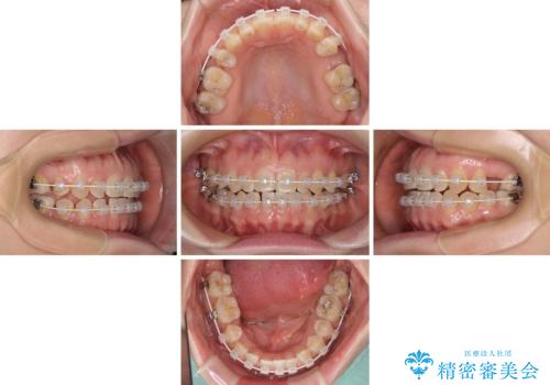 隙間の空いた歯列とボロボロの乳歯 インプラント治療と矯正治療の治療中