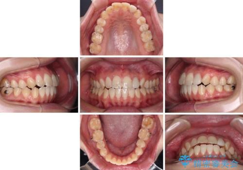 開咬を治す インビザラインによる矯正治療の治療中