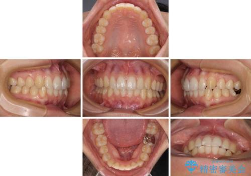 【モニター】前歯のデコボコとクロスバイト　インビザラインによる矯正治療の治療中
