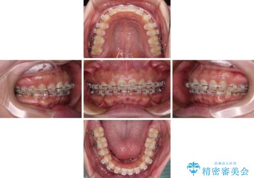 【モニター】ディープバイトを治す ワイヤー装置による矯正治療の治療中