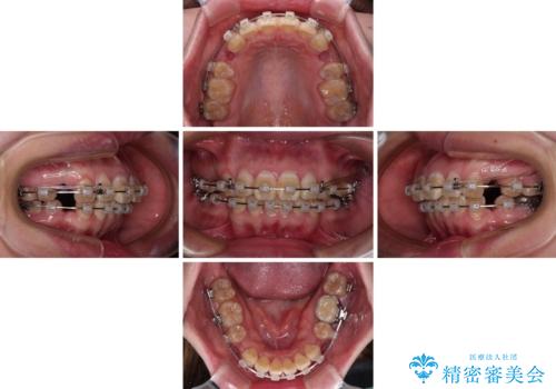 抜歯矯正で唇を閉じやすく ワイヤー矯正の治療中