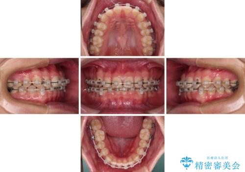 隙間とデコボコを治したい ワイヤー装置による矯正治療の治療中