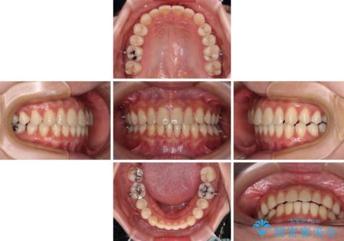 隙間の多い歯並びをインビザラインで矯正治療の治療中
