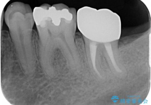 治療途中で放置してしまった歯 根管治療からのセラミック治療の治療後