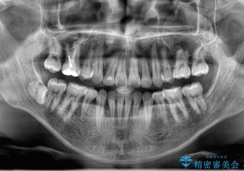 ガタガタの歯並び、八重歯をなおしたい、骨格性下顎前突　カモフラージュ矯正の治療後