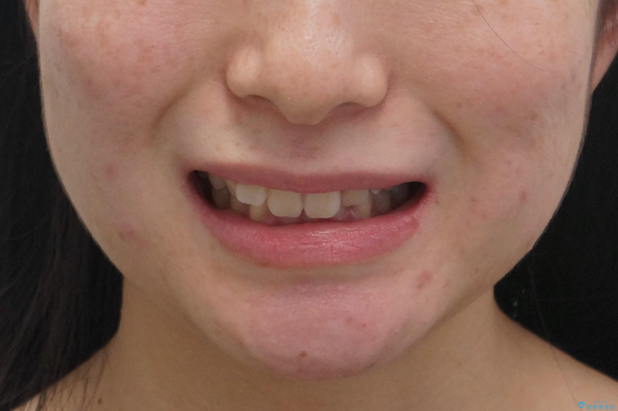 前歯のがたつき、八重歯　インビザラインで抜歯矯正の治療前（顔貌）