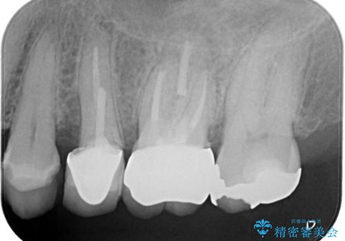 【破折ファイル除去】他院で折れた根管治療の器具をとってほしいの治療後