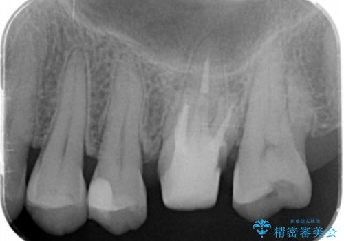 検査で見つかった虫歯 セラミッククラウンでの治療の治療中