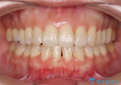 職業柄ワイヤー矯正ができない、マウスピース矯正で行う八重歯抜歯症例の治療後