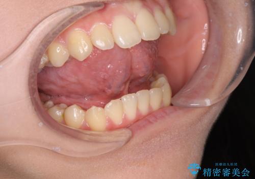 舌が短く話しづらい、滑舌を改善する小手術の治療前