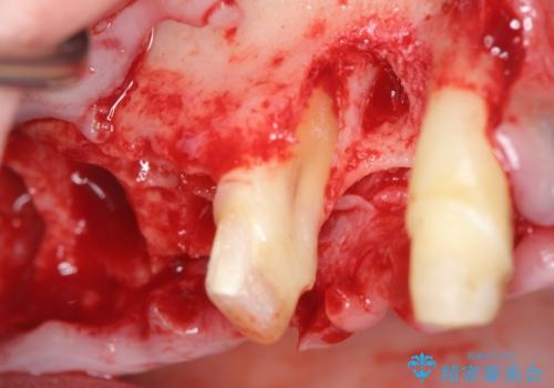 [ 重度の歯周病 ] 骨の造成を伴う奥歯インプラント治療