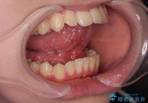 舌が短く話しづらい、滑舌を改善する小手術の治療後