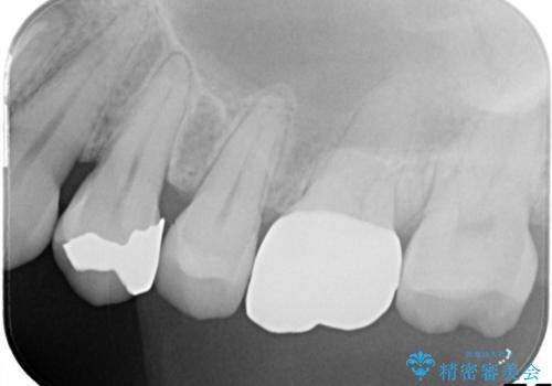 【根管治療・オールセラミッククラウン】何もしなくても歯が痛い 咬むと更に痛いの治療前