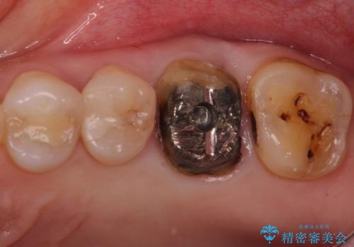 検査で見つかった虫歯 セラミッククラウンでの治療の治療中