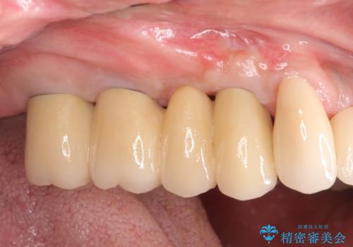 [ 重度の歯周病 ] 骨の造成を伴う奥歯インプラント治療の症例 治療後