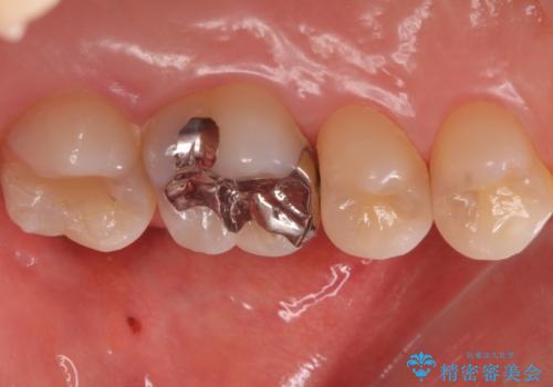 歯と歯の間の虫歯　インレーでの治療(セラミック・ゴールド)の治療前