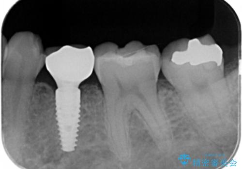 乳歯の残存　インプラントによる置き換えの治療後