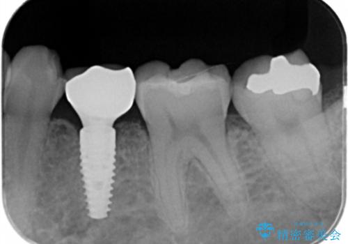 乳歯の残存　インプラントによる置き換え