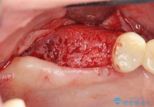 [ 重度の歯周病 ] 骨の造成を伴う奥歯インプラント治療の治療中