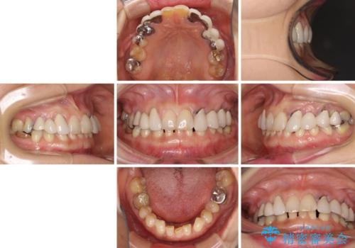 割れてしまった歯が痛む　矯正とインプラントを併用した総合歯科治療の治療前