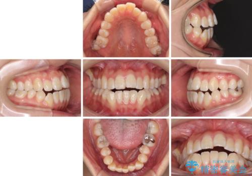 外に飛び出して磨きにくい奥歯と上下前歯の隙間　インビザラインによる矯正治療の治療前