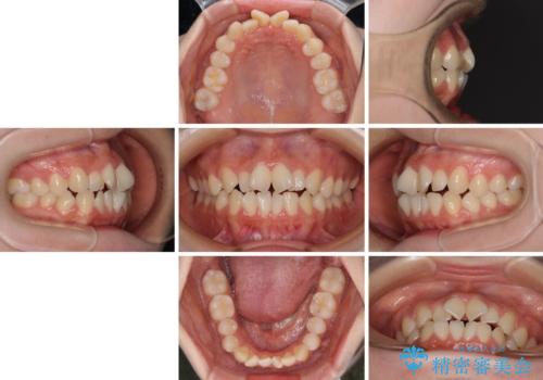 隙間が空いてデコボコした前歯を治したい ワイヤー装置による矯正治療の治療前
