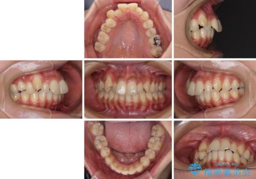 八重歯と出っ歯を治したい ワイヤー装置での抜歯矯正の治療前