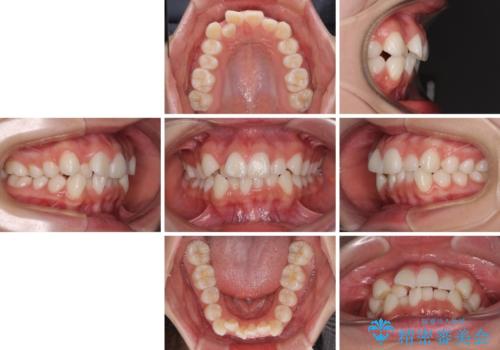 前歯のデコボコとクロスバイトを治したい ワイヤー装置による抜歯矯正の治療前