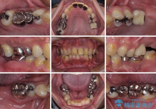 目立つ金属をすべてセラミックに 全顎的メタルフリー治療の治療前