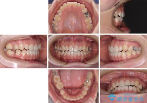 隙間の空いた歯列とボロボロの乳歯 インプラント治療と矯正治療の治療前